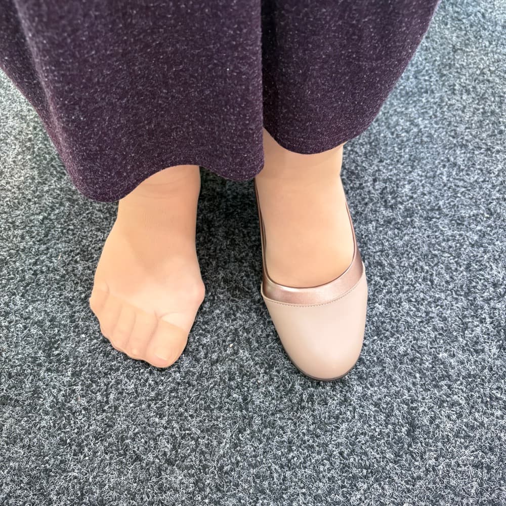 Hallux valgus fotografie