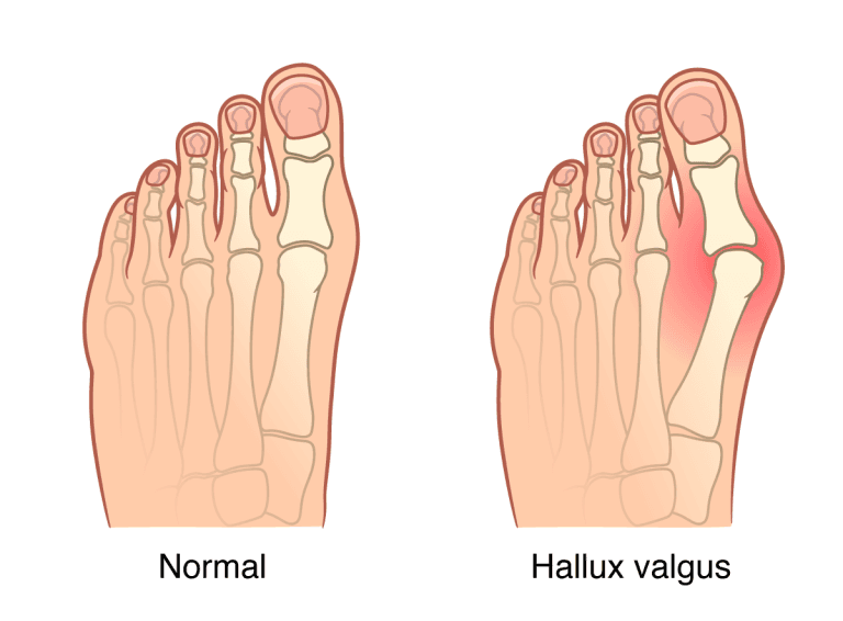 Srovnání normálního chodidla a chodidla s hallux valgus — ilustrace kostí a kloubů